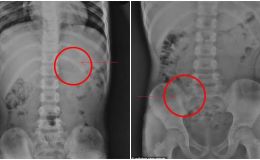 Bé trai 7 tuổi vô tình nuốt cây bút chì 10cm vào bụng, kết quả chụp X-quang gây ngỡ ngàng