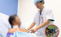 Đà Nẵng: Cụ ông bị ong vò vẽ đốt hơn 30 vết, suýt mất mạng vì sốc phản vệ độ 3