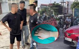 Bác sĩ hé lộ tình trạng sau ca mổ 6 tiếng của TikToker Hà Lits bị chém lìa tay ở Thái Nguyên