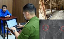 Hé lộ ‘quy trình’ tự đục vỡ xương, khớp để trục lợi bảo hiểm: Các đối tượng đối diện khung hình phạt nào?