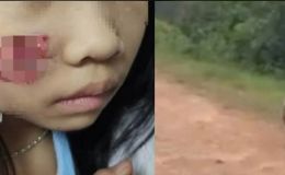Con khỉ hoang ở Quảng Bình tấn công 5 người: Cháu bé 7 tuổi phải nhập viện với nhiều vết thương