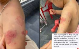 Bé hơn 2 tuổi chi chít vết bầm tím sau giờ học, lời giải thích gây tranh cãi từ giáo viên mầm non và nhà trường