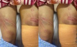 Nữ sinh lớp 7 nhập viện với nhiều vết bầm trên cơ thể: Gia đình nói tai nạn, chính quyền đang làm rõ