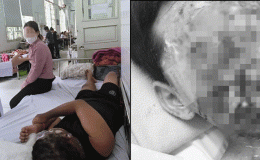 Gia đình xót xa khi mặt con trai bị biến dạng, chấn thương mắt nặng sau khi dùng pháo mua qua mạng