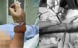 Lý do 2 vợ chồng ở Nghệ An bị điện giật khi dựng cây nêu đón Tết, 1 người nguy cơ cao cụt cẳng tay