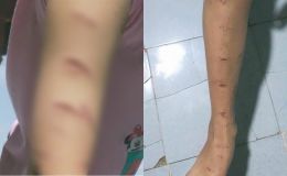 Lời khai người chị họ dùng dao rạch khắp người bé gái lớp 5, gia đình đưa ra hướng giải quyết