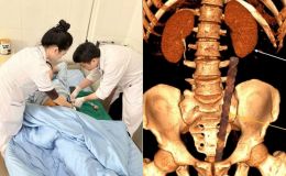 Quảng Ninh: Cấp cứu ca tai nạn hy hữu bị cọc sắt xuyên thấu ổ bụng sâu 30cm, hiện sức khỏe ra sao?