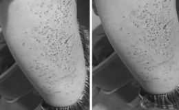 Lào Cai: Bất ngờ lý do khiến nam sinh lớp 7 bị bạn cùng lớp dùng bút bi đâm kín đùi