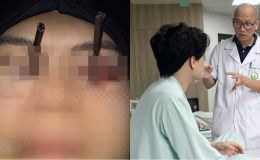 Phú Thọ: Tình hình thanh niên bị 2 đũa đâm sâu vào 2 mắt, y văn thế giới cũng chưa từng gặp phải