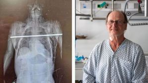 Khoảnh khắc kinh hoàng: Bác sĩ phẫu thuật rút thanh thép xuyên qua phổi của người đàn ông