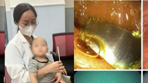 Hà Nội: Nuốt phải điếu thuốc lá chứa kim loại, bé 10 tháng tuổi suýt rơi vào 'án tử'