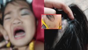Bé gái 3 tuổi toàn thân bầm tím, nhiều dấu răng trên người, giáo viên giải thích do bị bạn học 'cắn'