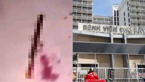 Nguyên nhân thanh niên 17 tuổi bị chém đứt lìa bàn tay ở Lâm Đồng, cập nhật tình hình nạn nhân