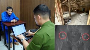 Hé lộ ‘quy trình’ tự đục vỡ xương, khớp để trục lợi bảo hiểm: Các đối tượng đối diện khung hình phạt nào?