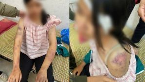 Tình hình sức khỏe của bé gái bị bà nội và người thân bạo hành dã man vì nghi ăn trộm tiền