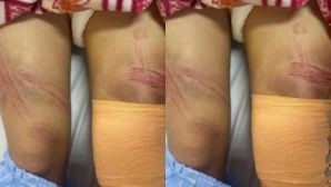 Nữ sinh lớp 7 nhập viện với nhiều vết bầm trên cơ thể: Gia đình nói tai nạn, chính quyền đang làm rõ