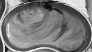 Người phụ nữ tiêm filler vùng mông gặp biến chứng sau nhiều năm, bác sĩ hút 3 lít dịch mủ, tình trạng hiện tại ám ảnh