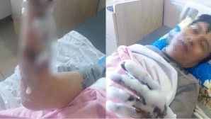 Thanh Hóa: Nam công nhân bỏng nặng 2 tay vì bị phóng điện, ngành chức năng công bố nguyên nhân