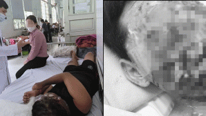 Gia đình xót xa khi mặt con trai bị biến dạng, chấn thương mắt nặng sau khi dùng pháo mua qua mạng