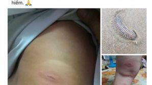 Sự thật không ngờ đằng sau màn kịch kêu gọi cứu trợ máu khẩn cấp cho cháu bé 3 tuổi bị sâu biển cắn