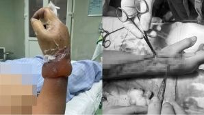 Lý do 2 vợ chồng ở Nghệ An bị điện giật khi dựng cây nêu đón Tết, 1 người nguy cơ cao cụt cẳng tay