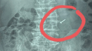 Người đàn ông nuốt phải chiếc đinh sắt nhọn vì thói quen khó bỏ, gia đình sững sờ khi phát hiện