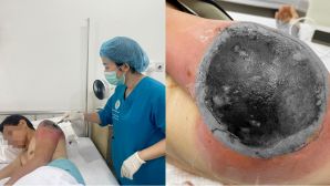 Người đàn ông suýt mất cả cánh tay vì đắp lá chữa chấn thương theo mẹo dân gian