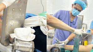 Bàn tay người phụ nữ cuốn chặt vào máy xay: Bác sĩ có quyết định khẩn để bảo vệ tính mạng bệnh nhân