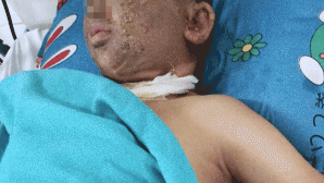 TP.HCM: Nam thanh niên mất một mắt sau khi thực hiện tục lệ quen thuộc ngày Tết, tình hình nạn nhân