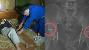 Thực nghiệm vụ tự đục xương nhận tiền bảo hiểm tại Phú Thọ, nhóm đối tượng diễn lại hành vi chiếm đoạt 6 tỷ đồng