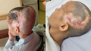 TPHCM: Cô gái đột quỵ sau phẫu thuật thẩm mỹ, vùng đầu biến dạng nghiêm trọng