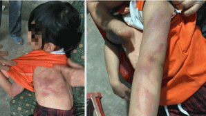 Bé gái lớp 2 bị bạn nam cùng lớp đánh bầm tím khắp người vì không ‘giữ lời hứa’, tình hình nạn nhân?