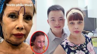 Hậu 'trùng tu nhan sắc', cô dâu 63 tuổi ở Cao Bằng gặp biến chứng phẫu thuật nặng nề