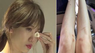 Khán giả xót xa khi nhìn thấy hình ảnh Hari Won chằng chịt vết bầm tím trên cơ thể