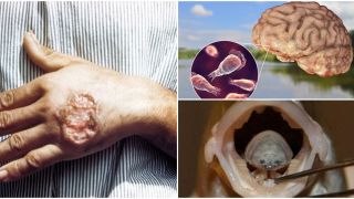 4 loại ký sinh trùng ‘ăn thịt’ đặc biệt nguy hiểm: Loại kí sinh ăn mắt có ngay ở phòng tắm, hồ bơi