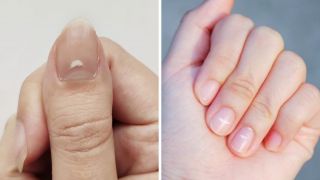 Cẩn thận với loạt dấu hiệu trên móng tay có thể là biểu hiện của bệnh tật mà ít người để ý