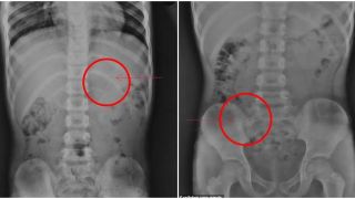 Bé trai 7 tuổi vô tình nuốt cây bút chì 10cm vào bụng, kết quả chụp X-quang gây ngỡ ngàng