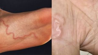 Sở thích ăn đồ sống có thể khiến bạn nhiễm giun rồng mà không hề hay biết