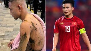 Trước thềm đấu ĐT Việt Nam, 'Ronaldo Malaysia' tái xuất với diện mạo khó tin sau khi bị tạt axit