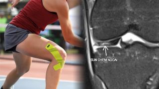 Chấn thương khi chơi pickleball: Chuyên gia chỉ cách khắc phục, tránh biến đam mê thành gánh nặng