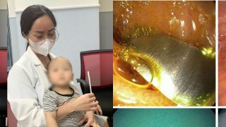 Hà Nội: Nuốt phải điếu thuốc lá chứa kim loại, bé 10 tháng tuổi suýt rơi vào 'án tử'