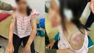 Tình hình sức khỏe của bé gái bị bà nội và người thân bạo hành dã man vì nghi ăn trộm tiền