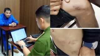 Rùng mình quá trình cựu nhân viên y tế tự đục vỡ xương để trục lợi bảo hiểm, hành vi quá man rợ