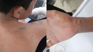 Ninh Bình: Lén đốt pháo, bé trai 12 tuổi gặp thảm kịch khiến cả gia đình bàng hoàng