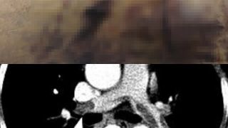 Sau 48 giờ phẫu thuật hút mỡ và nâng ngực, một nữ Việt kiều 60 tuổi tử vong: Hé lộ nguyên nhân