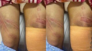 Nữ sinh lớp 7 nhập viện với nhiều vết bầm trên cơ thể: Gia đình nói tai nạn, chính quyền đang làm rõ