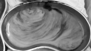 Người phụ nữ tiêm filler vùng mông gặp biến chứng sau nhiều năm, bác sĩ hút 3 lít dịch mủ, tình trạng hiện tại ám ảnh