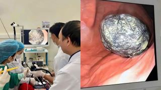 Quảng Ninh: Bé gái 5 tuổi suy dinh dưỡng nặng, chỉ 13kg, bác sĩ phát hiện búi tóc lớn trong dạ dày