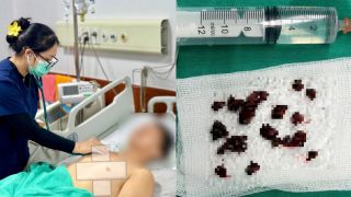 Phụ Thọ: Người đàn ông phát hiện nhiễm loại nấm đen hiếm, có thể ăn mòn xương, đe dọa tính mạng