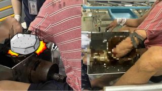 TP.HCM: Nam công nhân bị cuốn cả cánh tay vào máy xay thịt, ám ảnh tình trạng khi nhập viện cấp cứu